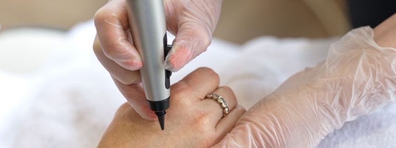 CryoPen behandeling bij Goldskin Clinic Bilthoven